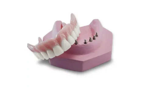 Implant-supported snap-on denture superstructure in San Miguel de Allende, designed for secure fit and easy removal.