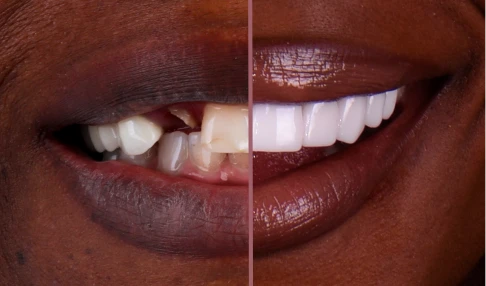 before and after, treatment snap on dentures in San Miguel de Allender