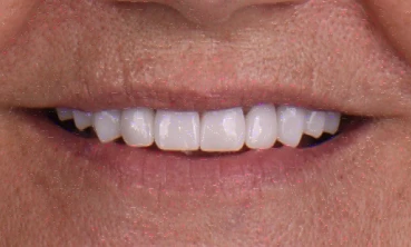 Close-up of a humble, subtle smile showcasing brilliantly white teeth after a professional teeth whitening treatment.