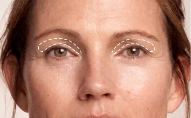 Woman patient before and after picture, one with rhinoplasty results, floral background